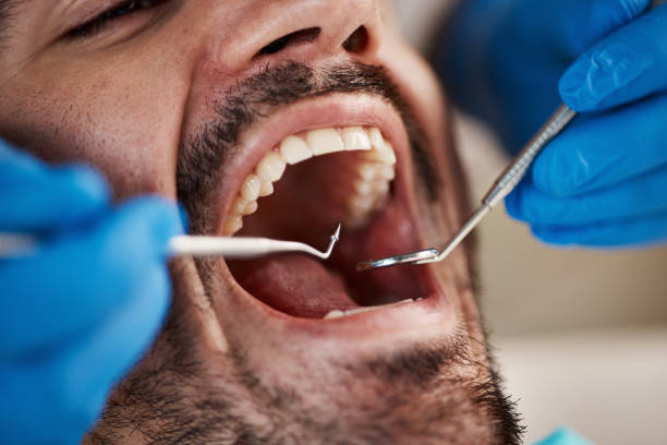 Best Emergency Wisdom Teeth Removal in Vass, NC